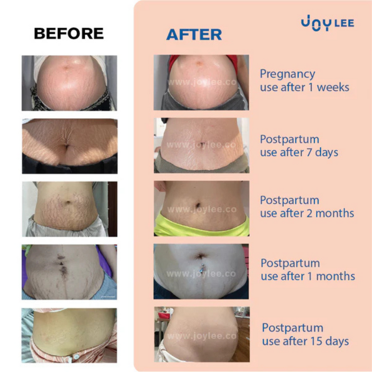 Joylee Radiance Stretch Mark Oil 100ml