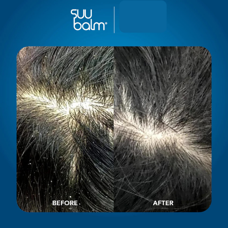 Suu Balm Rapid Itch Relief Scalp Spray Moisturiser 40ml