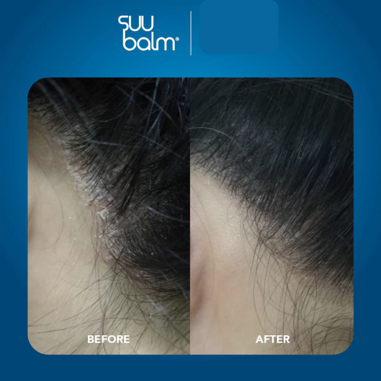 Suu Balm Rapid Itch Relief Scalp Spray Moisturiser 40ml