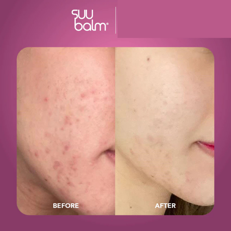 Suu Balm Cooling Itch Relief Facial Moisturiser 50ml